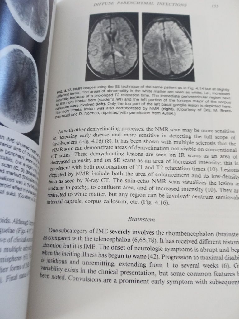 Imaging of Infections and inflammtions of the central nervous system