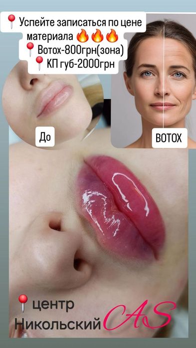 Косметолог/Ботокс/Збільшення губ/МОДЕЛІ