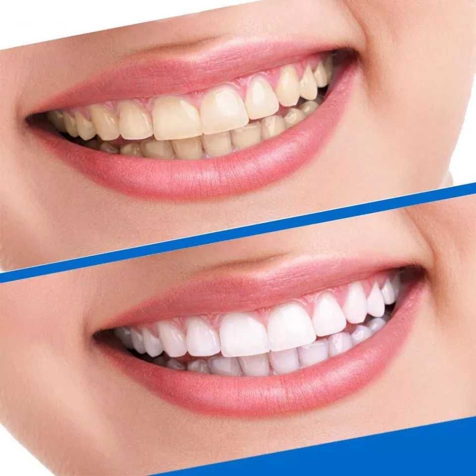 Отбеливающие полоски для зубов | 5D WHITE TEETH | Отбеливание зубов