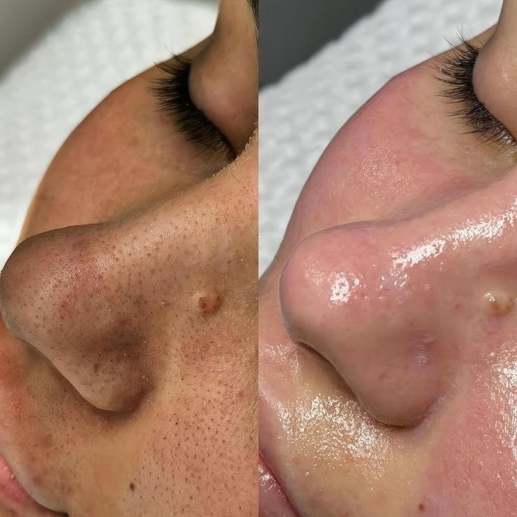 Limpeza de Pele Malveira
