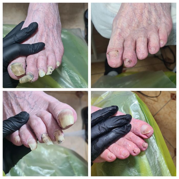 Подолог. Медицинский аппаратный педикюр