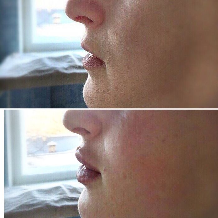 Губи та Ботокс  Новорічні знижки !!!