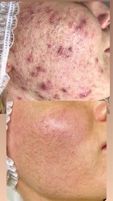 Лечение акне, врач дерматолог , врач косметолог.