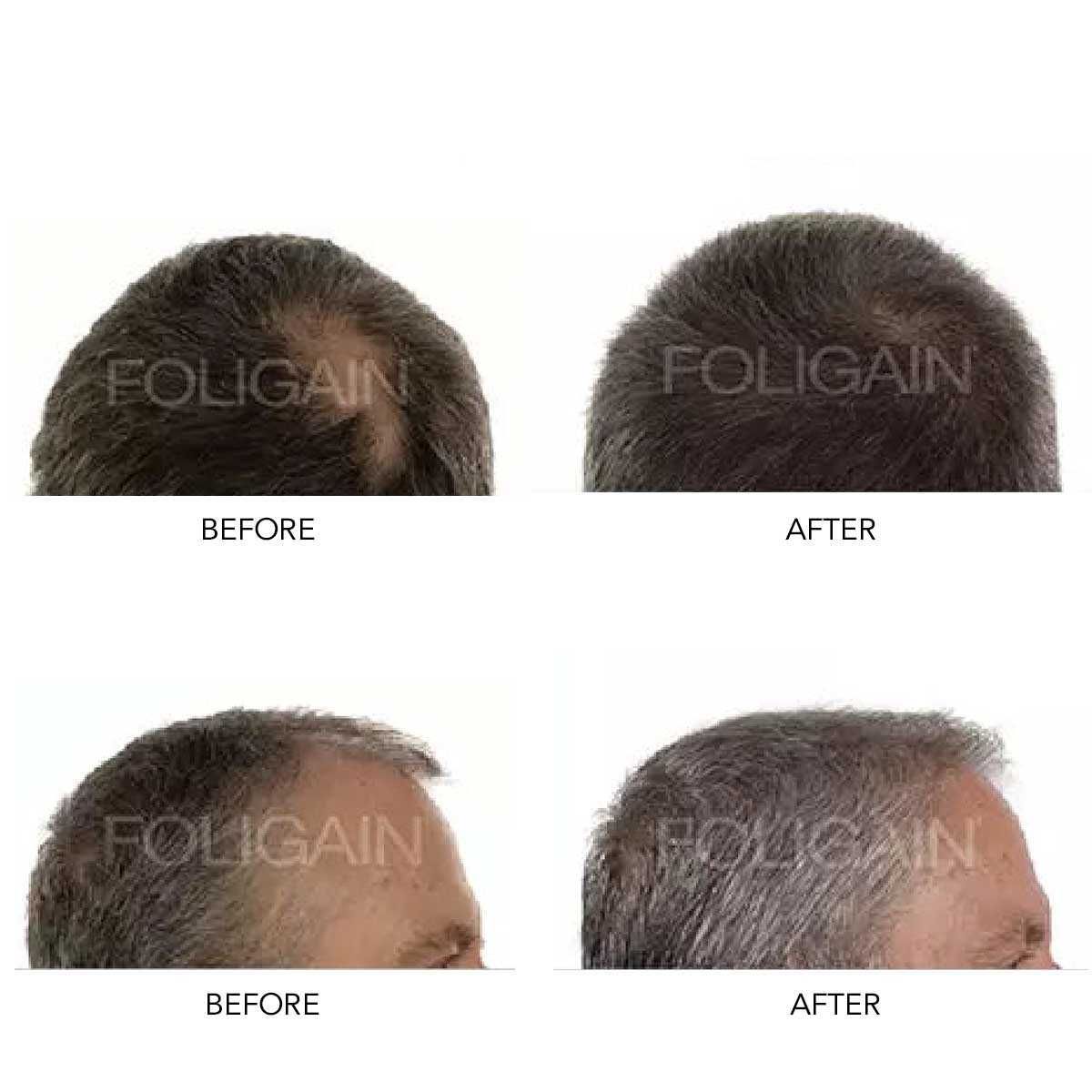 kit 3 Minoxidil tb versão baixo Álcool Entrega Grátis em Cascais
