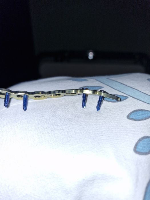 Титанова пластина для фіксації ключиці права