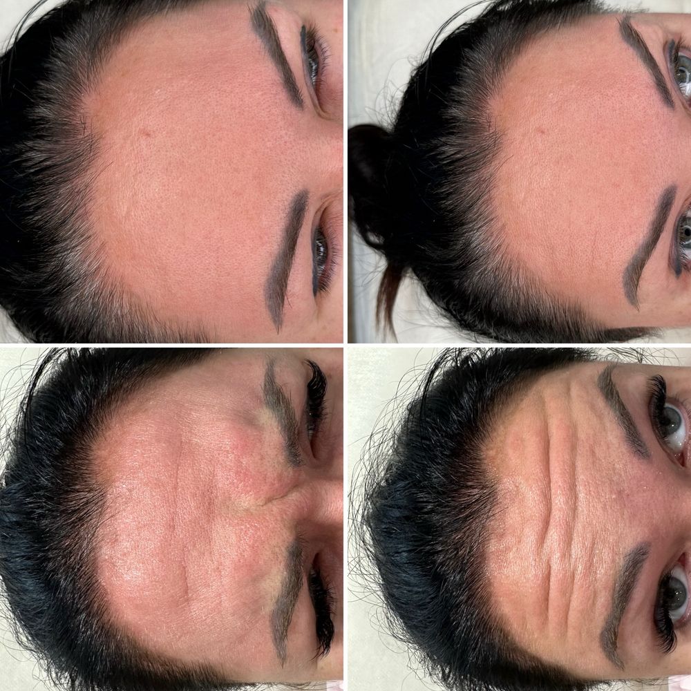 Medycyna estetyczna Modelowanie ust Wolumetria Botoks Stymulatory