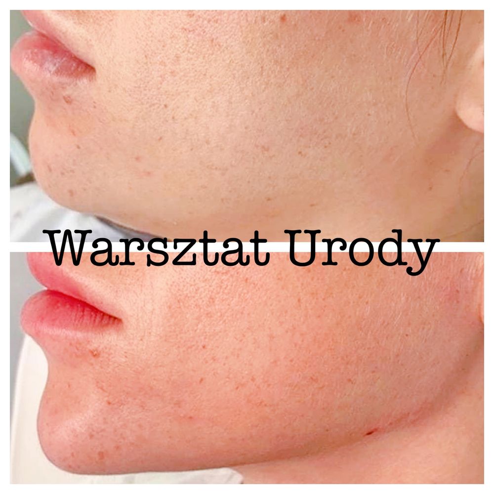 250zł= Botox - Botoks/ PLASMA IQ/ Wolumetria/ Powiększenie Ust -300zł