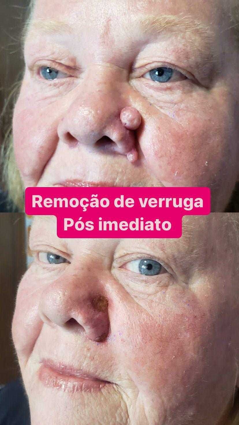 Remoção de verrugas de todos os tipos