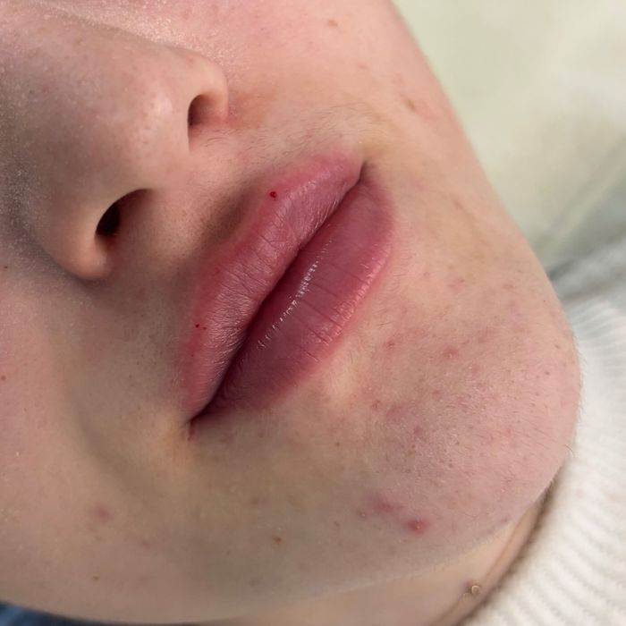 Безкоштовно збільшення губ / контурна пластика губ / ботокс