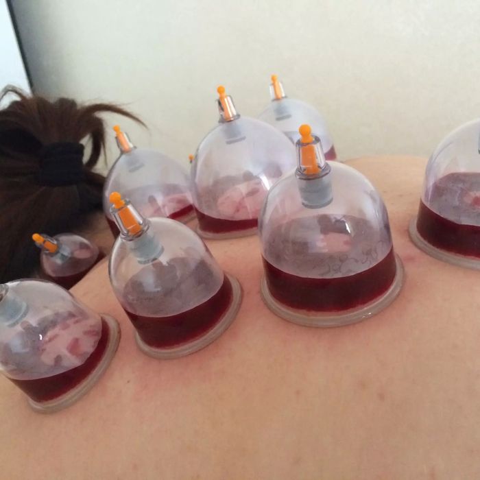 ХИДЖАМА в Кропивницком / Доктор Евгений.Вызов на дом