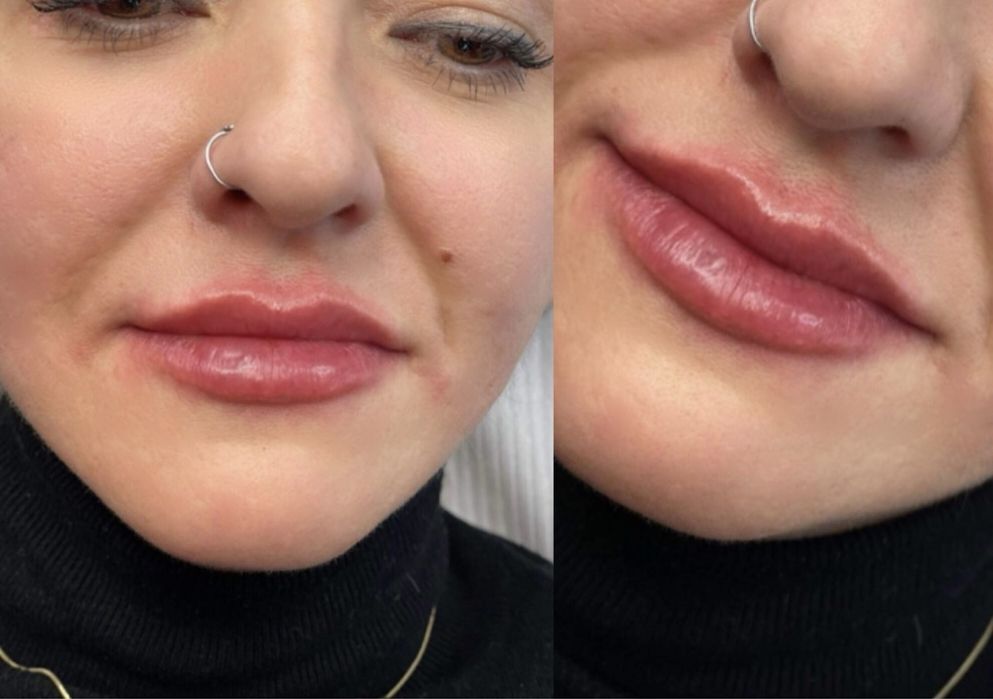 Btx ,Powiekszanie ust permanentny brwi i ust, stymulatory tkankowe