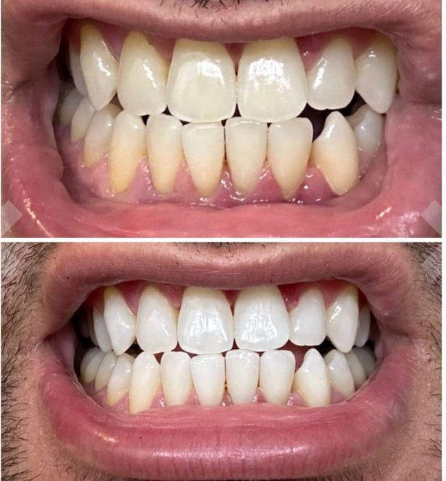 Paski Wybielające Crest 7 Levels , oryginalne z USA