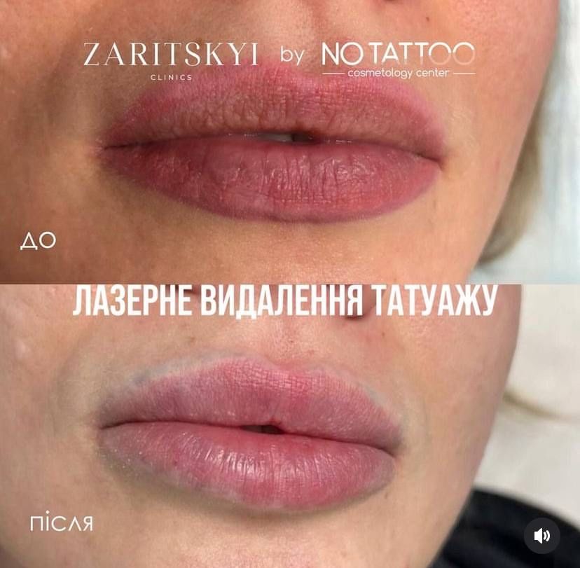 Лазерне видалення татуажу