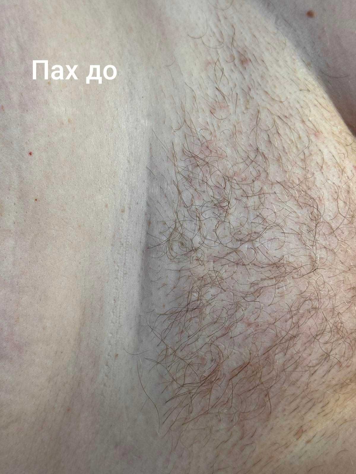 Депіляція воском.Холодна гора.