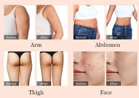 Cavitação e Radiofrequência Corpo e Rosto