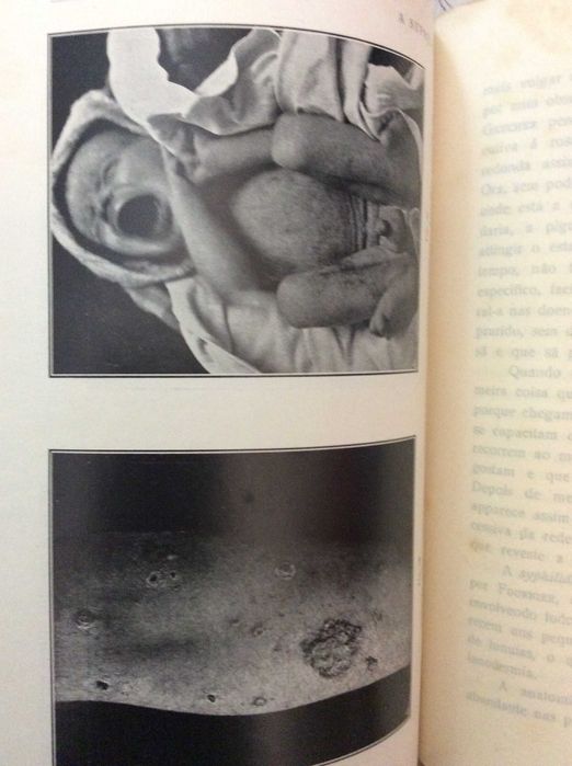A Syphilis - Suas manifestações tegumentares. Imagens impressionantes.