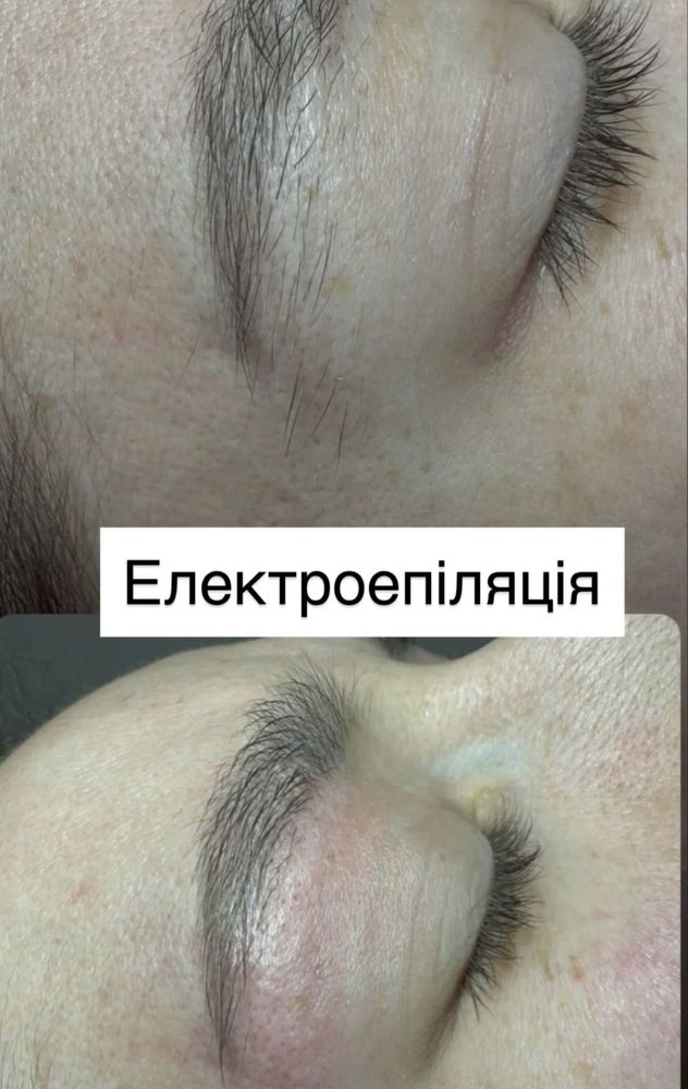 Електроепіляція-видалення небажаного волосся назавжди