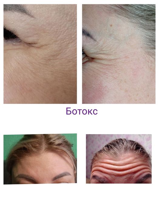 Косметолог Кривой Рог(губы, ботокс,чистка лица)