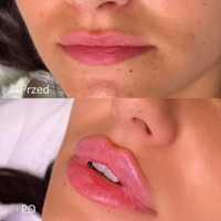 Powiększanie ust russian lips 1ml350zł,2ml450zł,botox,nici4D,lipoliza