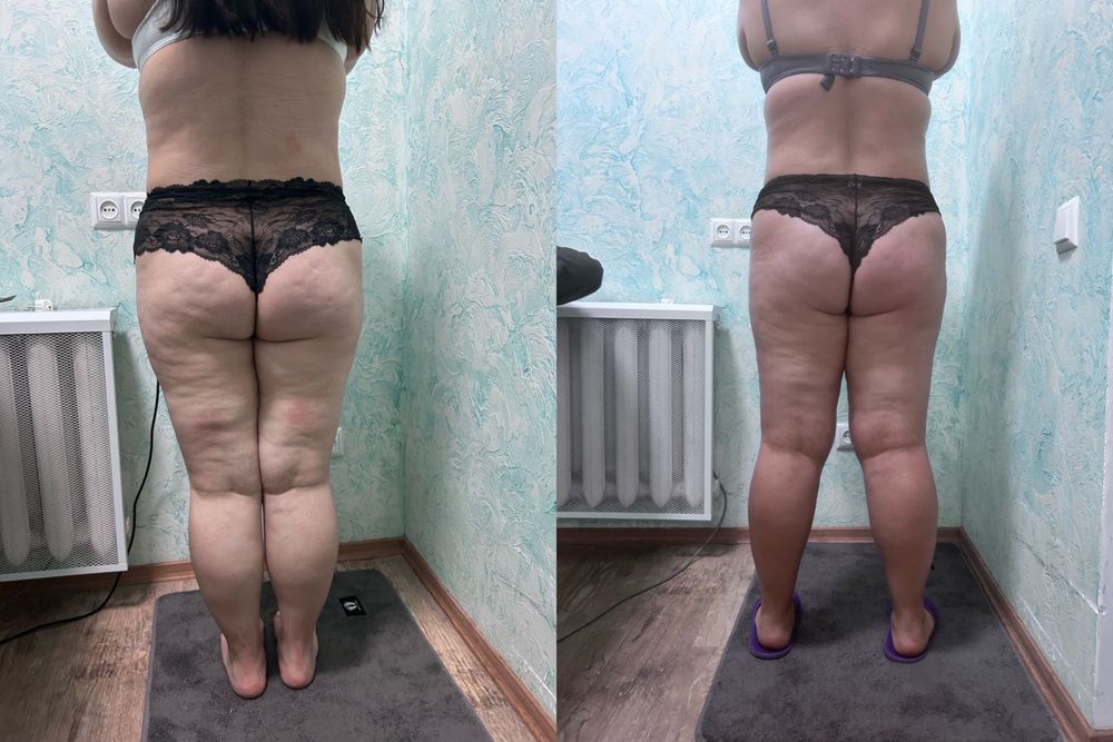 Дівчата запрошую на антецилюлітний масаж п.(Котовського)