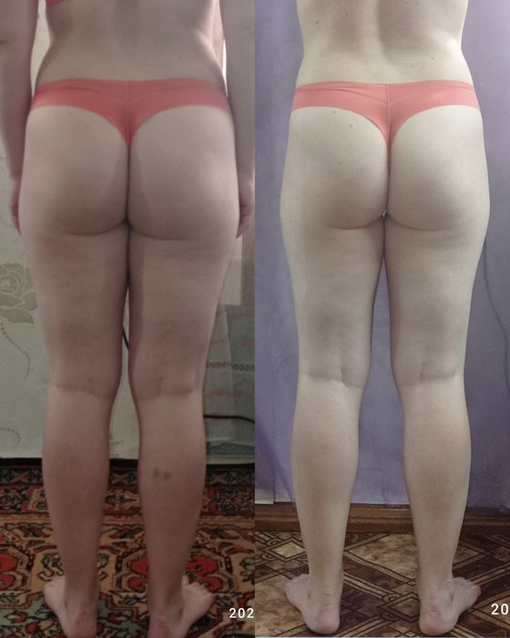 Масаж вакумний(апаратний) Антицел-тний; Шугаринг;Титова.