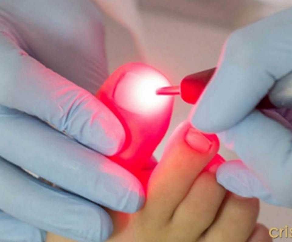 laser Podológico