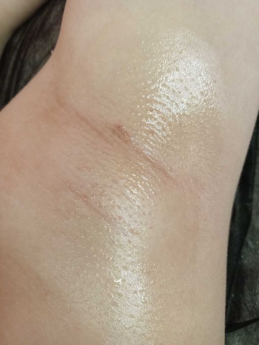 Воскова депіляція/Мікронідлінг/Мезотерапія/Вакуумно-роликовий масаж