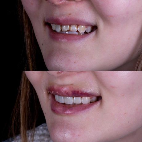 Лечение зубов Недорого. Протезирование стоматолог Качественно Полтава.