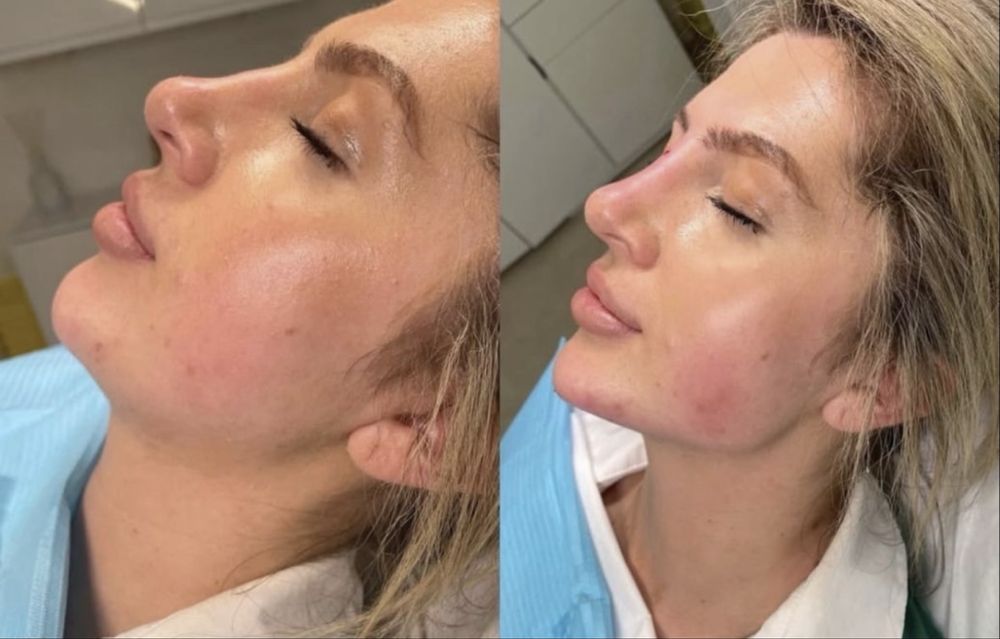 Моделі для збільшенення губ