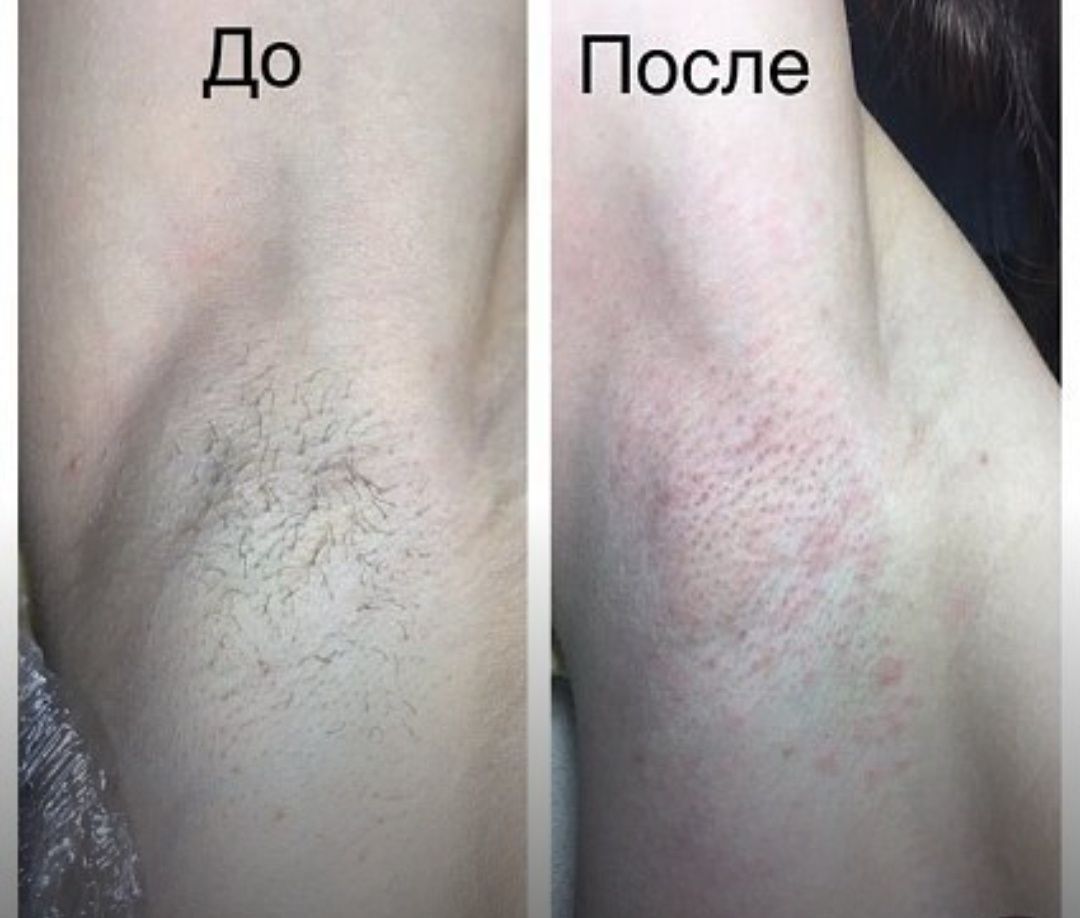 Електроепіляція на Виноградарі