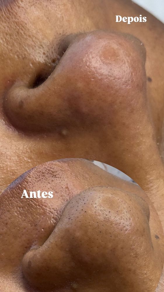 Limpeza de pele