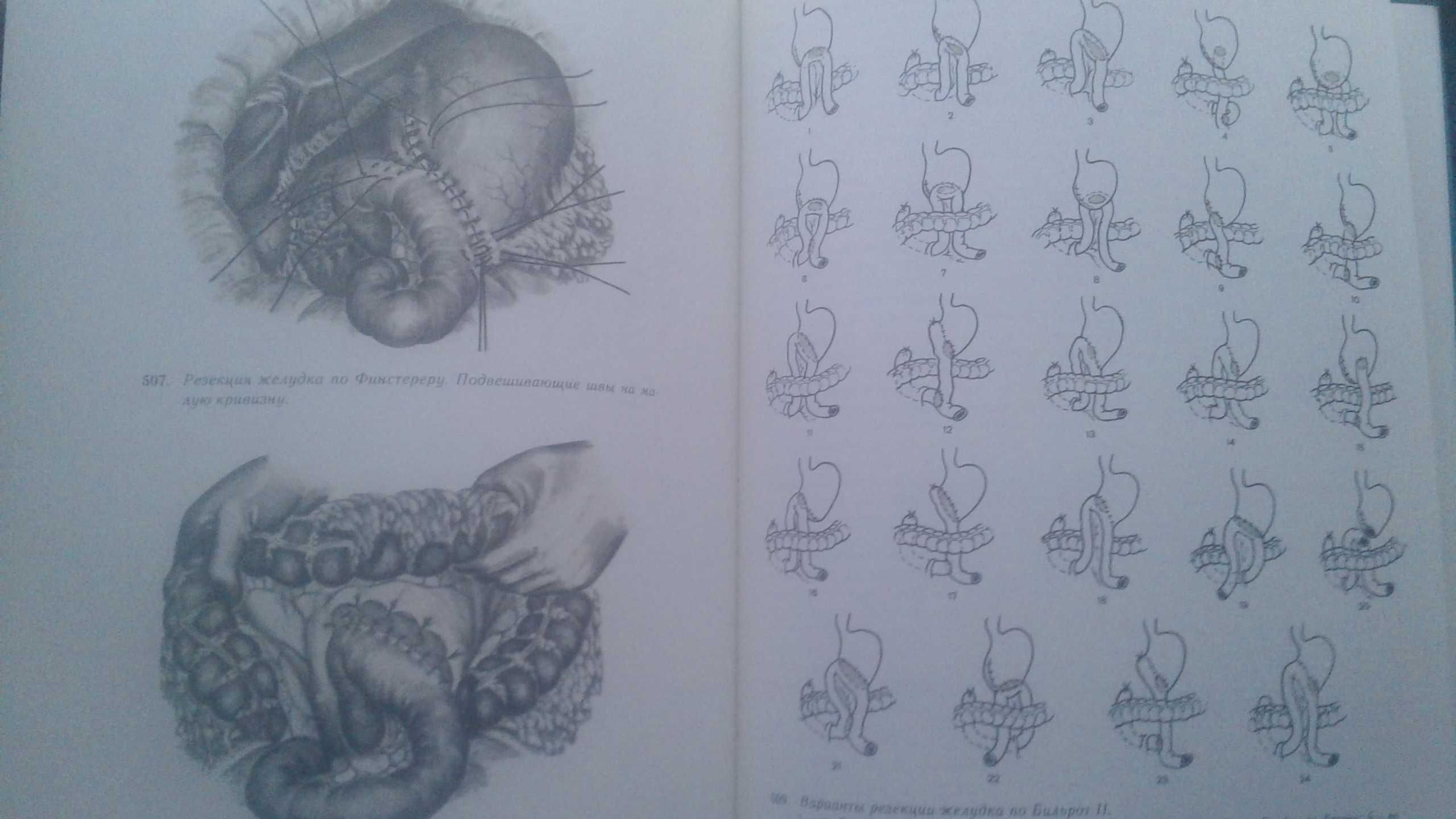 Атлас операций на пищеводе желудке и двенадцатиперстной кишке Шалимов
