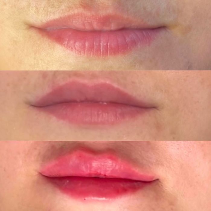 Модель на губы  ботокс Угли Джоли скули