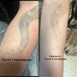Удаление татуировок на неодимовом лазере, не дорого