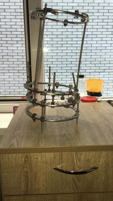 Аппарат Илизарова - 4 кольца