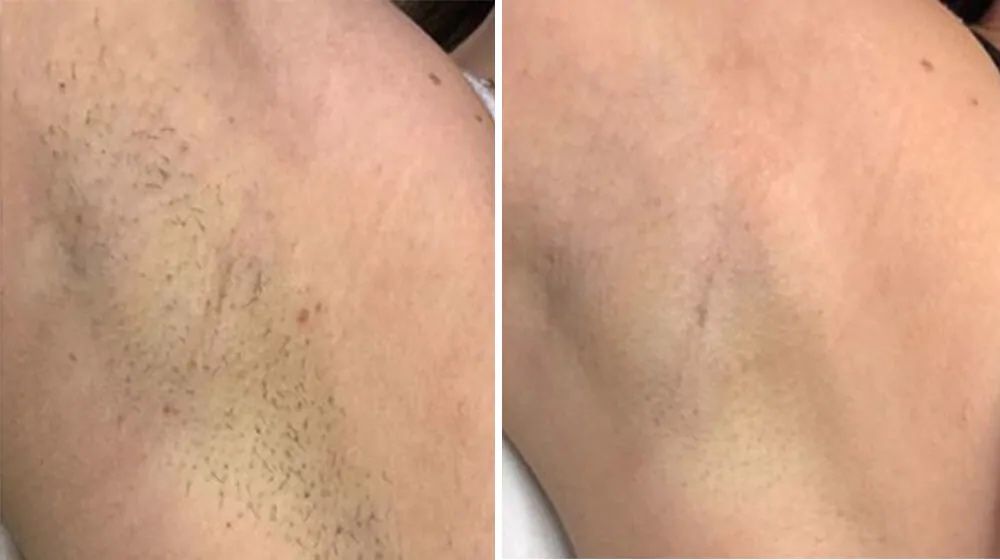 Zabieg Depilacji Laserowej / Endermologii -30% na wszystko