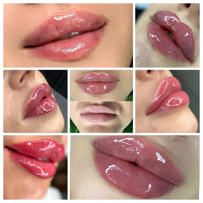 Powiekszanie ust, powiększanie, modelowanie ust