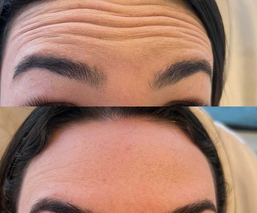 Ботокс Ботулінотерапія зморшок