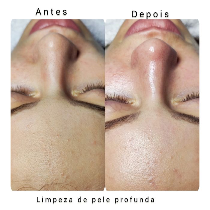 Limpeza de pele profunda