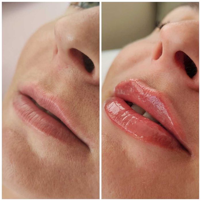 Увеличение губ, контурная коррекция