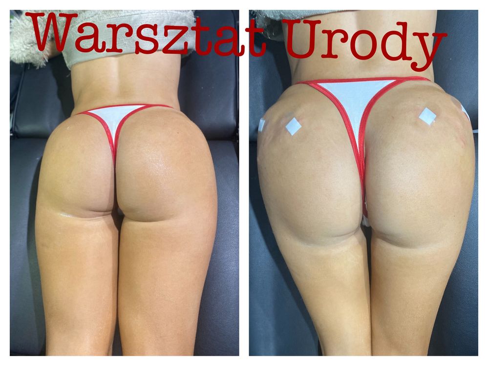 250zł= Botox - Botoks/ PLASMA IQ/ Wolumetria/ Powiększenie Ust -300zł