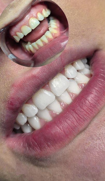 Kosmetyczne wybielanie zębów