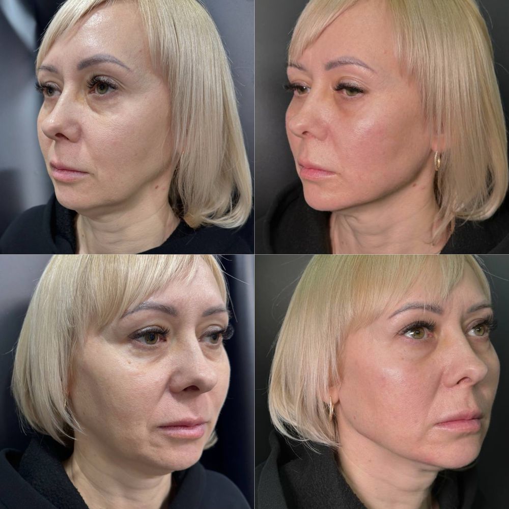 Губы Контурная пластика лица, углы Джоли,скулыподбородок,Трк Украина