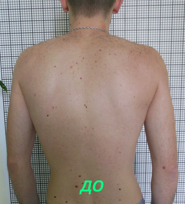 Гарантоване лікування сколіозу у дітей і дорослих