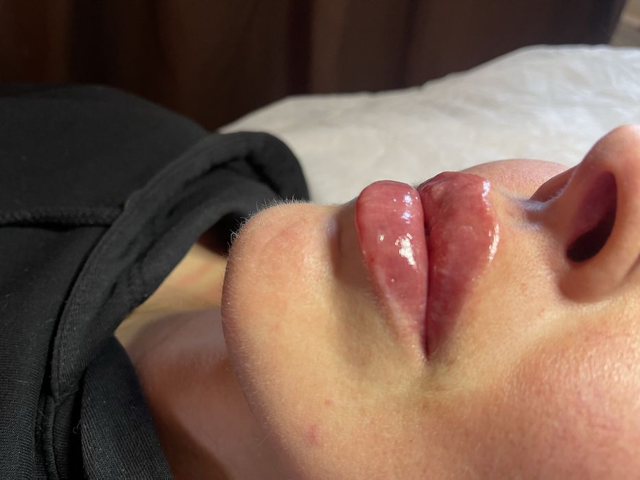 Контурна пластика губ від 3000 ботокс 1000