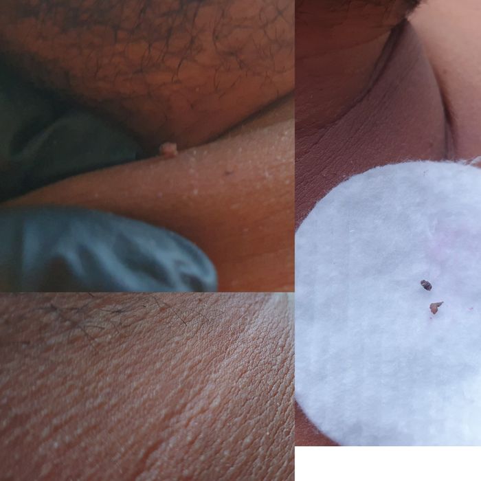 remoção de verrugas e rejuvenecimiento!