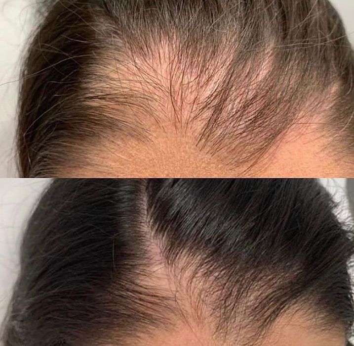 Трихолог, випадіння волосся, алопеція, пілінг шкіри голови, лупа