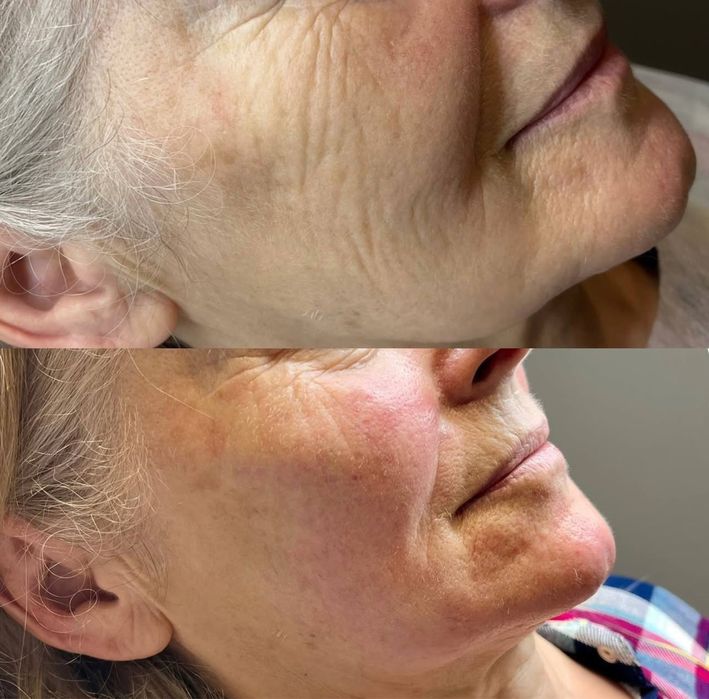 Косметолог Николаев ,губы 3500,ботокс биоревитализация