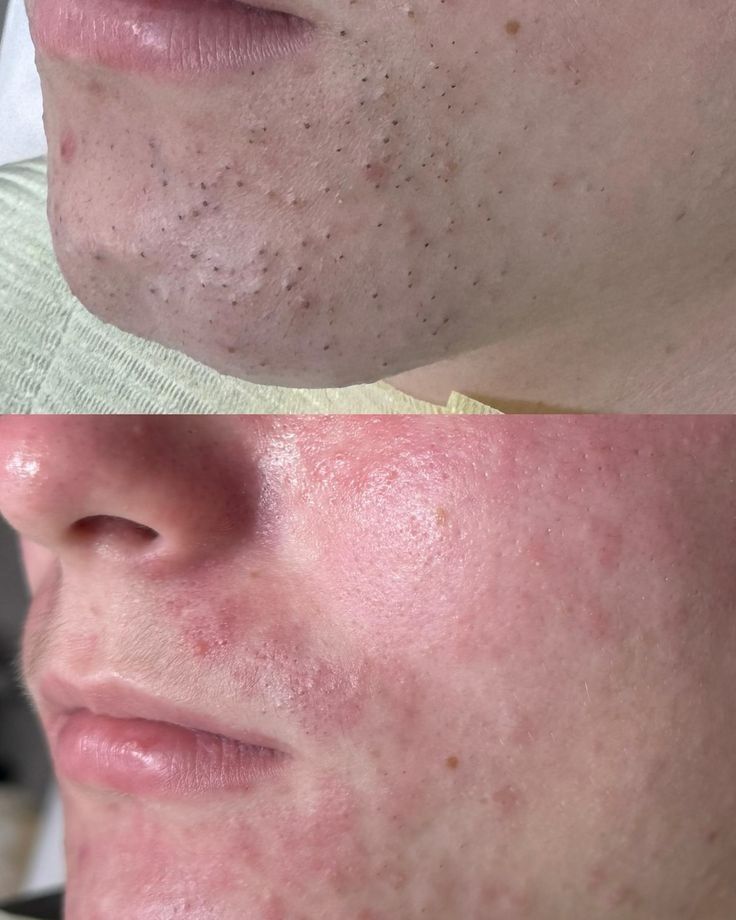 Limpeza de Pele Malveira