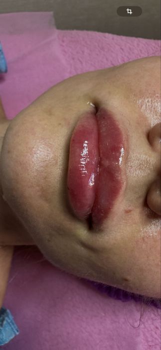 Збільшення губ Ботокс Розчинення губ